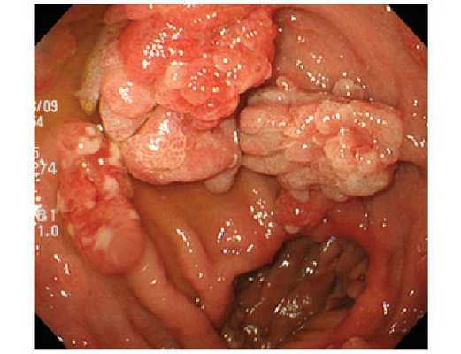 Трансанальная эндоскопическая микрохирургия