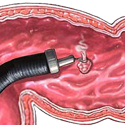 Эндоскопическое удаление полипа