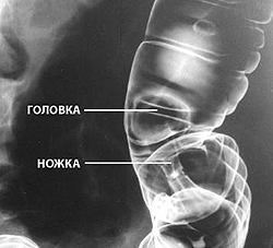 Полип (головка и ножка)