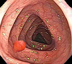 Полип толстого кишечника (колоноскопия)