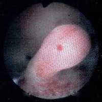 Полипы матки