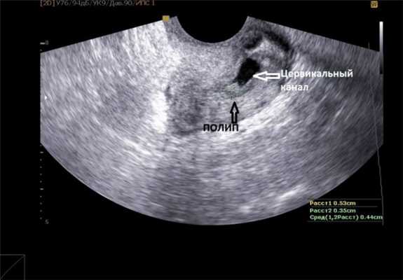 полип цервикального канала