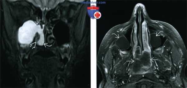 КТ, МРТ при солитарном полипе носа, пазухи