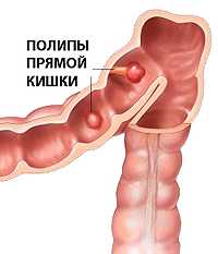 Полипы кишечника