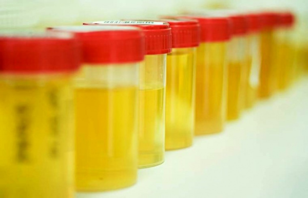 Исследование мочи