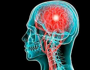 Фото Ретроцеребеллярная киста головного мозга