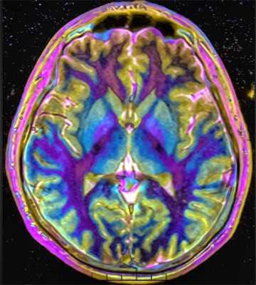 головной мозг в цвете-норма