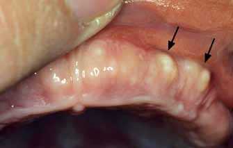 Десневая киста в полости рта новорожденного