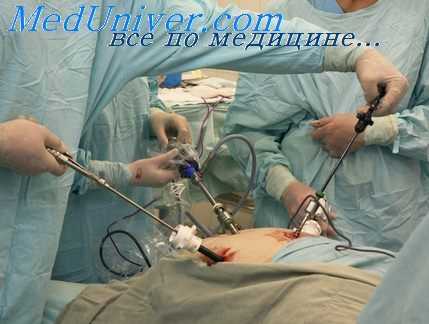 лапароскопия