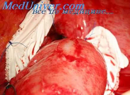 эзофагоскопия