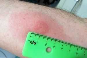 реакция на пробу у взрослых