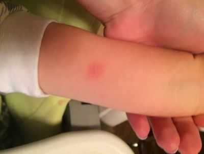 реакция на пробу Манту у ребенка