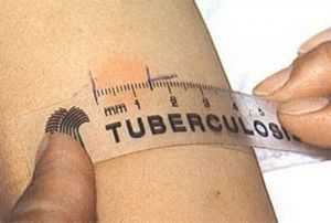 проба на туберкулёз