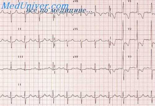 гипертрофия отделов сердца на экг