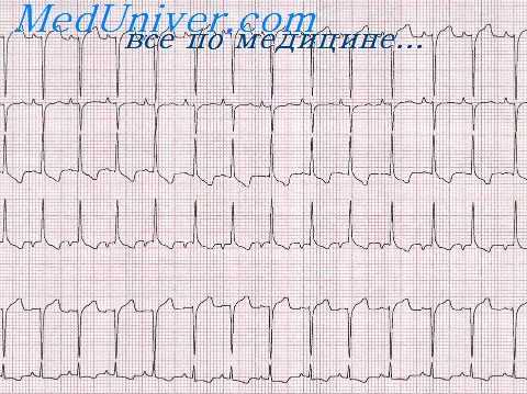 экг при гипертрофии