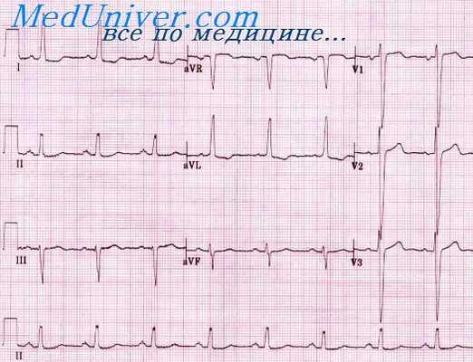 гипертрофия сердца