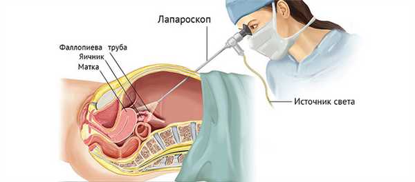 Лапароскопия в гинекологии