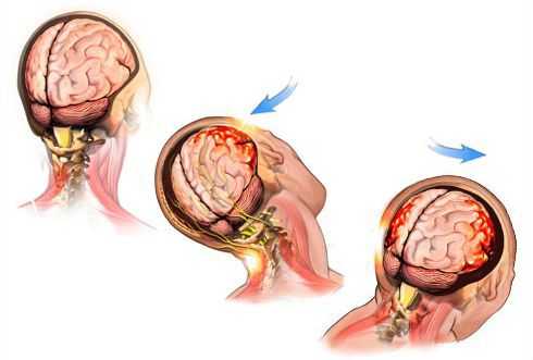 Повреждение головного мозга при сотрясении