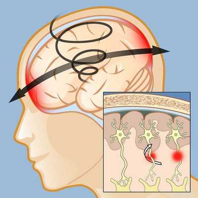 Нарушение связей клеток мозга при сотрясении