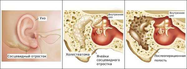 Острый средний отит