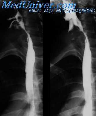 исследование пищевода
