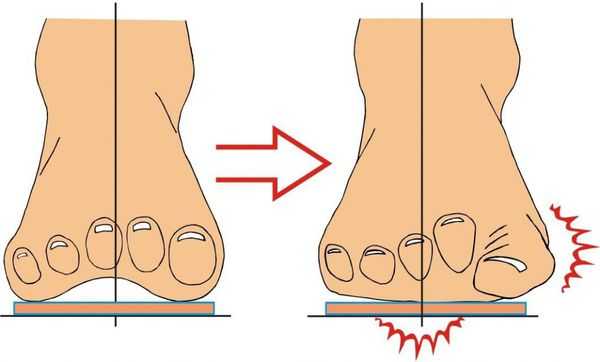 Уплощение поперечного свода стопы