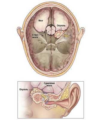 Рост опухоли в сторону мозга