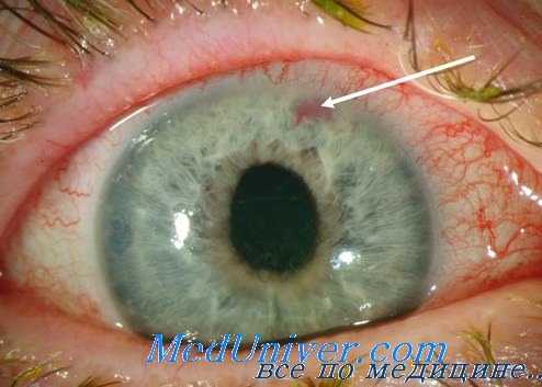 фурфуроловая глаукома