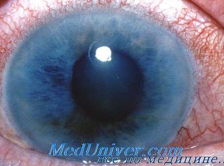 поражение глаз на нефтеперерабатывающих предприятиях