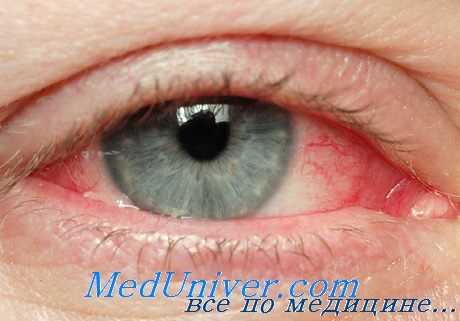 поражение глаз аскаридами