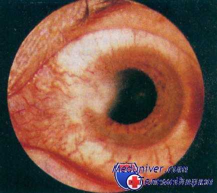 кератит при аскаридозе