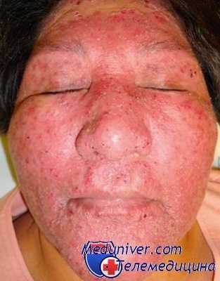 демодекоз глаз