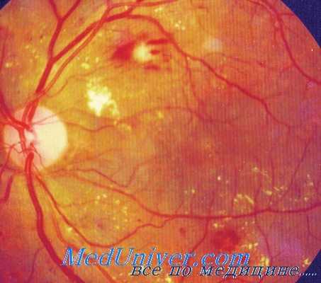 бабезиоз глаз