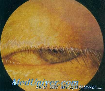 клиника демодекоза