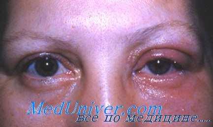 помутнение хрусталика от фтора