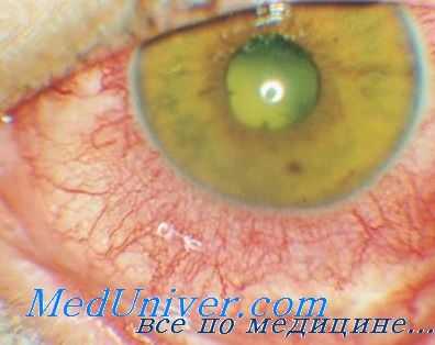 поражение глаз фтором