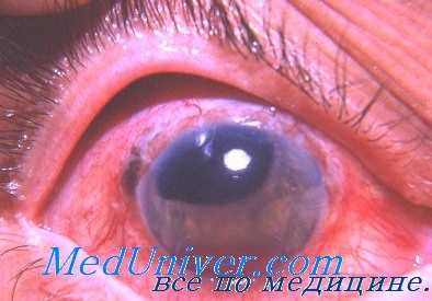 поражение глаз фурфуролом