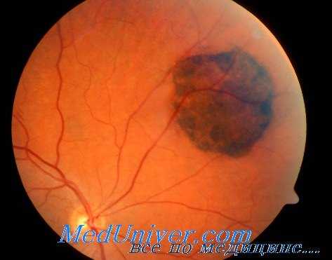 токсическое поражение глаз