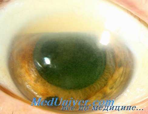 поражение глаз кремнием