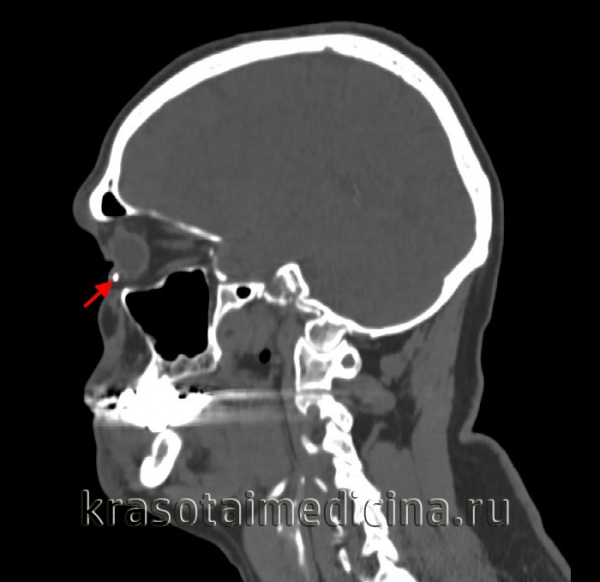 Видео осмотра глаза при боковом фокальном освещении
