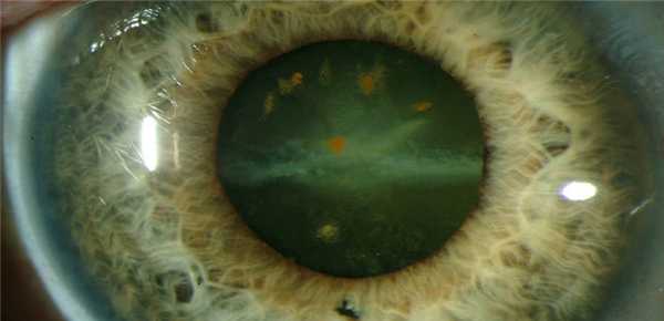 Сидероз симптомы