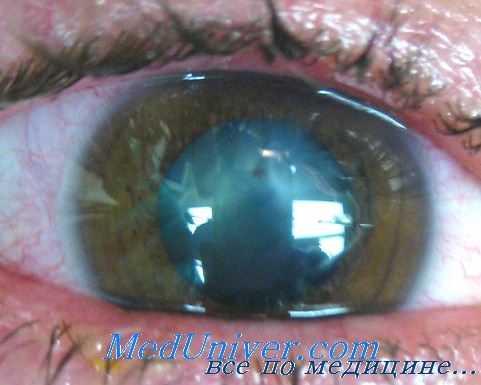 поражение глаз мышьяком