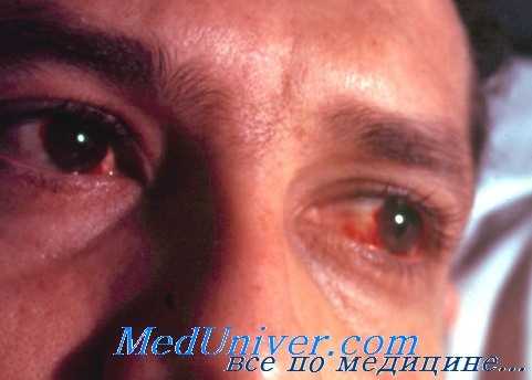 поражение глаз при туляремии