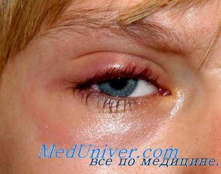 поражение глаз при менингите