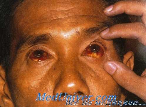 глаза при лихорадке паппатачи