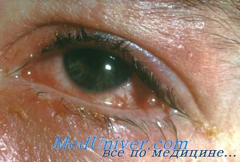 трипаносомоз глаз