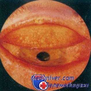 поражение глаз при лейшманиозе