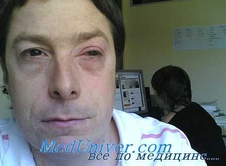 лоалоз глаза