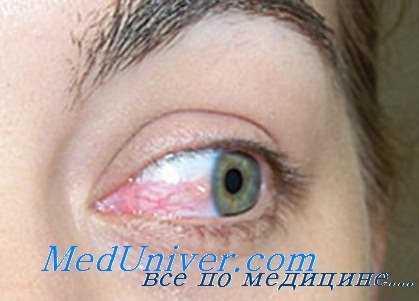 глаз при возвратном тифе