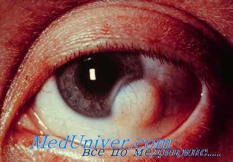 лейшманиоз глаз